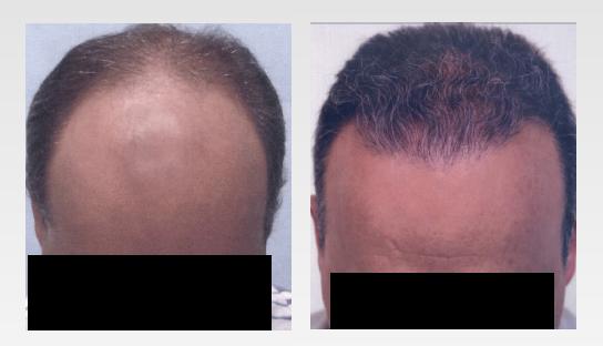 Before and after hair transplant procedure