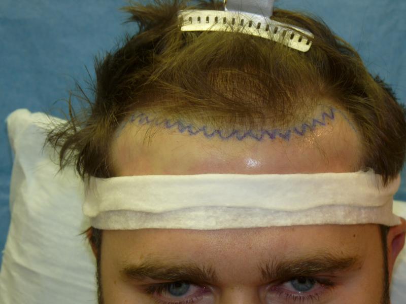 pre op hairline drawn in