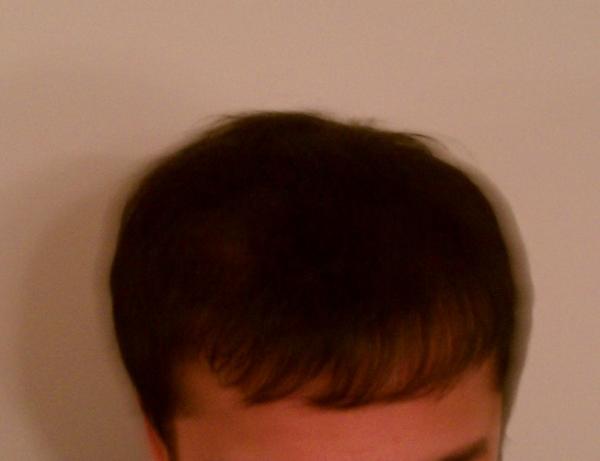 Image uploaded by: My2nd 1800graft procedure