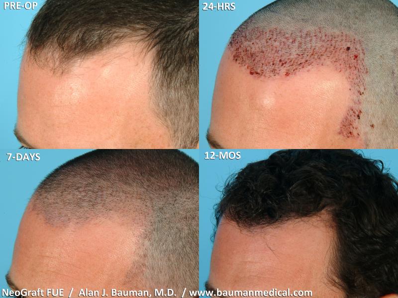 neograft(0910) pre op 1day 1wk 12mo Lfront; FUE procedures using the 0.8mm NeoGraft handpiece allows for the harvesting of hair follicles for transplantation without the 'tell-tale' linear scar.  Recovery is faster and more comfortable and less restricted. This patient, seen here before his procedure (upper left),  24 hours post-op (upper right), 7 days post-op (lower left), and at 12 months post-op (lower right), reveals the design of the transplanted hairline--including the adjustment to the temporal point, and how the scabbing from the newly transplanted hairline is resolved at 7 days post-op. Notice the quality of the skin healing at 7 days, which reveals very mild redness and residual stubble.  At 12 months, 90% of the results from his hair transplantation are seen, with adequate coverage.  This procedure was performed by Dr. Alan J. Bauman, M.D. at Bauman Medical Group in Boca Raton Florida.