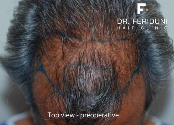 Image uploaded by: Dr Feriduni Hair Clinic