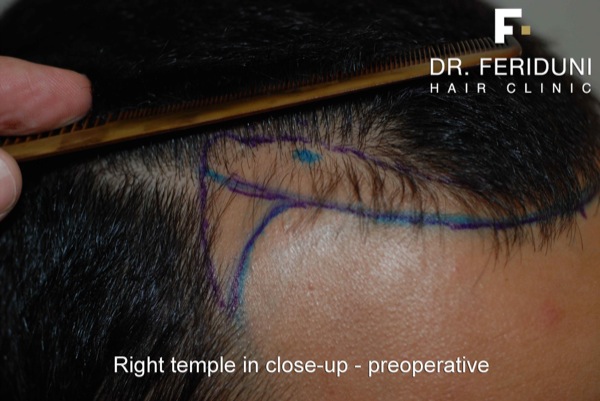 Image uploaded by: Dr Feriduni Hair Clinic