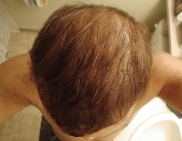 Top of my head which is mostly filled in but still areas towards the back which have some balding/thinning areas.