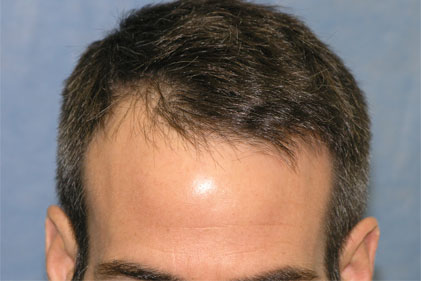 Before Hair Transplant

View his full photoset >> http://www.bernsteinmedical.com/hair-transplant-photos/portraits/patient-rpc/
