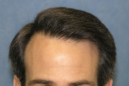 Detail of Hairline - After 1st Hair Transplant Session

View his full photoset >> http://www.bernsteinmedical.com/hair-transplant-photos/portraits/patient-rpc/
