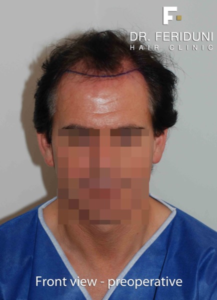Image uploaded by: Dr Feriduni Hair Clinic