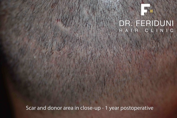 Image uploaded by: Dr Feriduni Hair Clinic