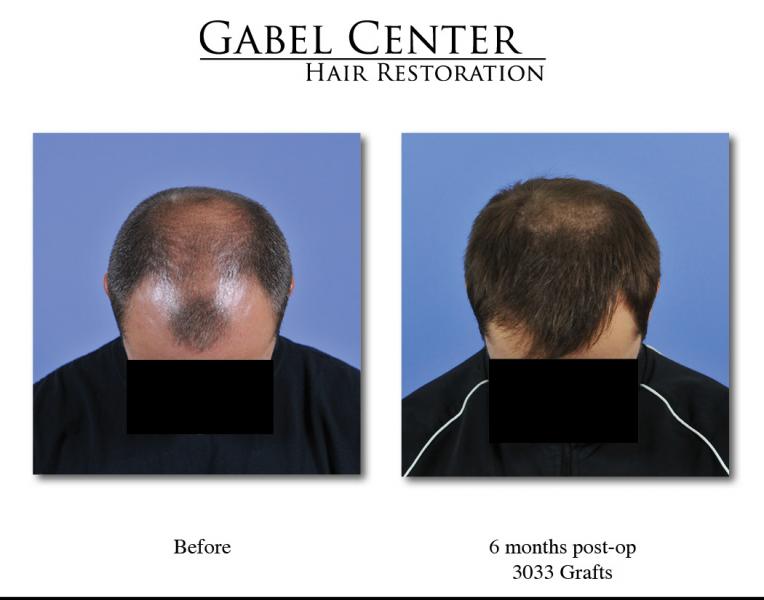 Dr. Gabel Patient: 6 months with excellent growth