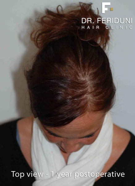 Image uploaded by: Dr Feriduni Hair Clinic