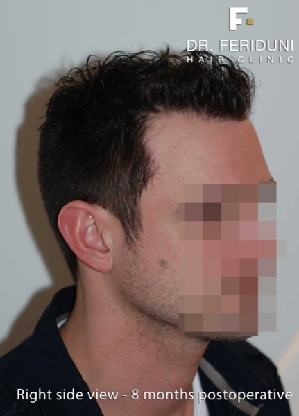 Image uploaded by: Dr Feriduni Hair Clinic
