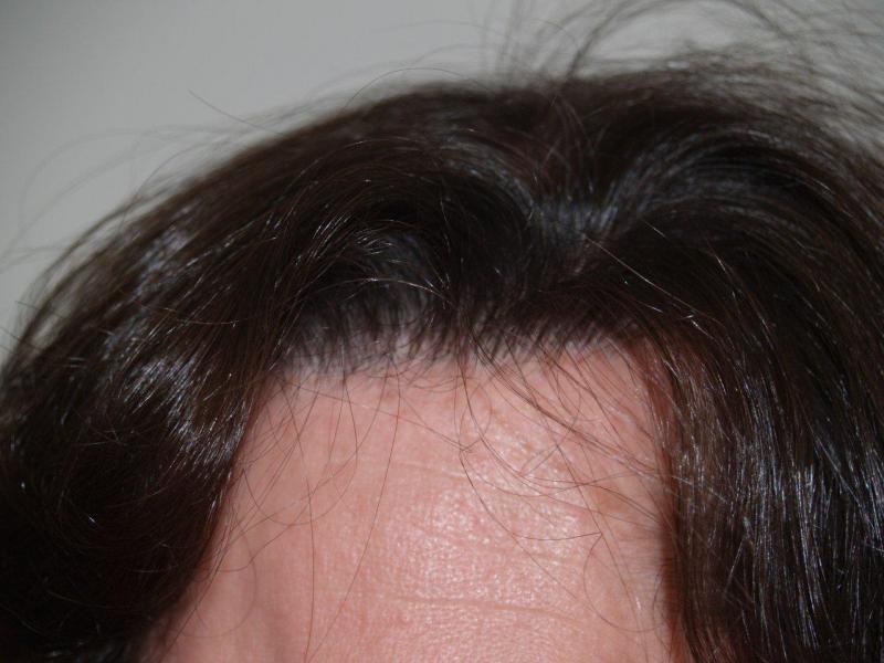 Hairline After Scalp Flap Repair