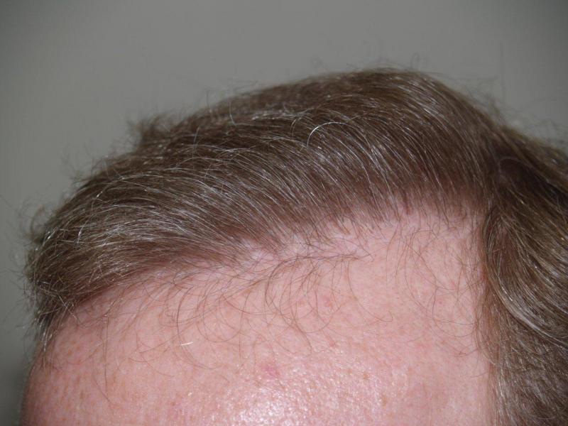 Close-up of after revision hair transplant procedure