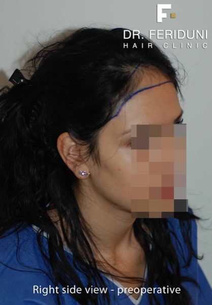 Image uploaded by: Dr Feriduni Hair Clinic