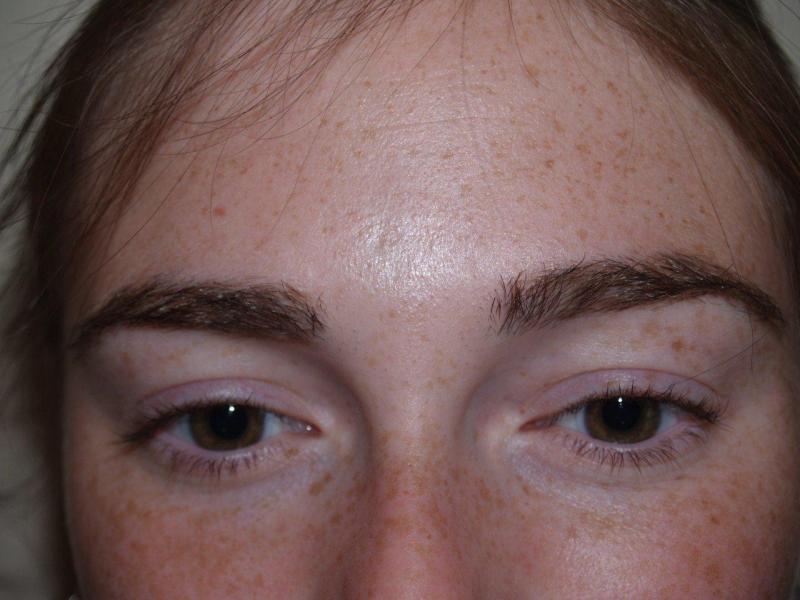 After Eyebrow Hair Transplant Procedure