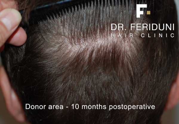 Image uploaded by: Dr Feriduni Hair Clinic