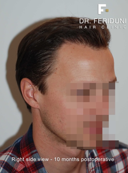 Image uploaded by: Dr Feriduni Hair Clinic