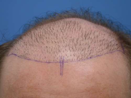 The Shave down, notice the poor placement like stadium row seating and the way the grafts exit my scalp, scar tissue and my lumpy head which was why I could never buzz it