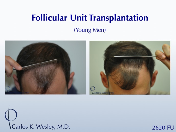 Slide2A 26-yr-old male Before/After 2060 grafts from Dr. Carlos K. Wesley.

An interactive Before/After image can be viewed here:
www.drcarloswesley.com/frontal_18.html
