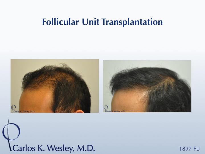 35-year-old male as seen before/after 1897 graft session with Dr. Carlos K. Wesley in NYC.

A video of this patient's experience can be viewed here:
www.drcarloswesley.com/videos_13.html