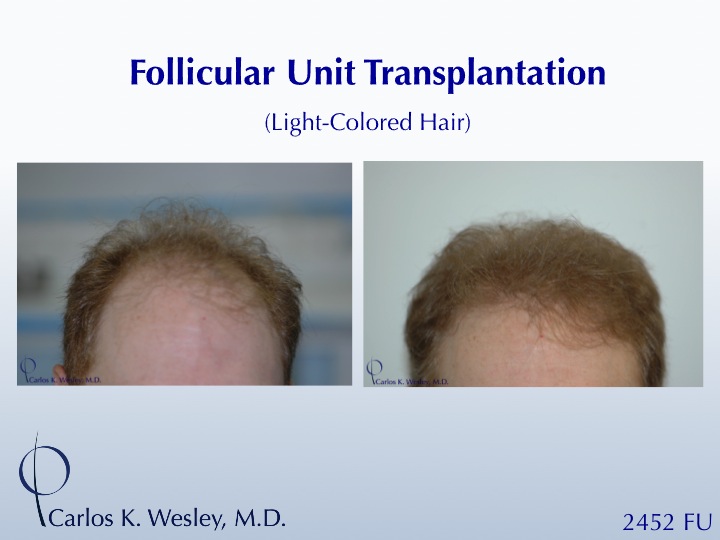 This patient can be seen before/after a 2452 grafts session with Dr. Wesley's office in NYC.

An interactive before/after image of this patient can be viewed at:
www.drcarloswesley.com/frontal_15.html