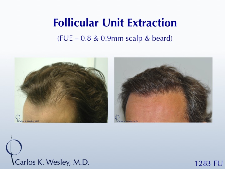 This patient had 1283 FUE grafts from beard and scalp with Dr. Carlos K. Wesley in NYC.  

An interactive before/after image can be viewed here:
www.drcarloswesley.com/improve_density04.html

A video of this patient's experience can be viewed here:
www.drcarloswesley.com/videos_08.html