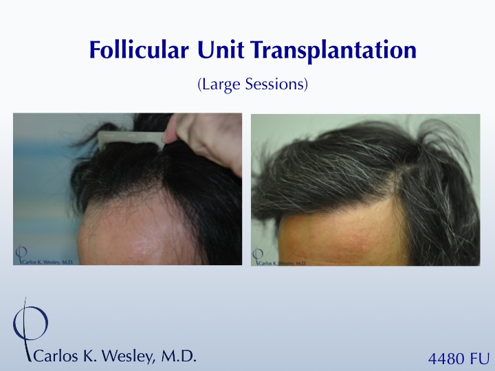 This 43-year-old man desired to reverse the progressive recession of his hairline. A total of 4480 grafts were transplanted to the frontal half of his scalp in order to create a natural-appearing hairline with considerable fullness.

A video of this patient's experience can be viewed here:
www.drcarloswesley.com/videos_17.html