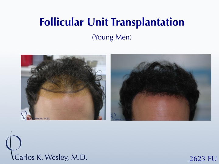 An interactive before/after of this patient can be viewed at:
http://www.drcarloswesley.com/frontal_10.html

This 26-yr-old man was referred by his hairdresser after attempting Propecia for over 3 years with minimal effect. A session of 2632 micrografts throughout his frontal third effectively strengthened his hairline and framed his face.