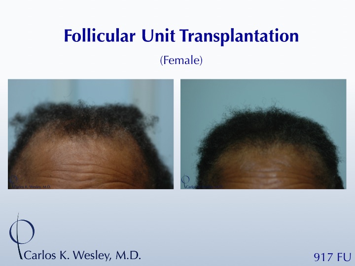 Female Patient Before/After a 917 grafts session with Dr. Carlos K. Wesley in NYC.

An interactive before/after image of this patient may be viewed at:
www.drcarloswesley.com/temporal_recessions01.html