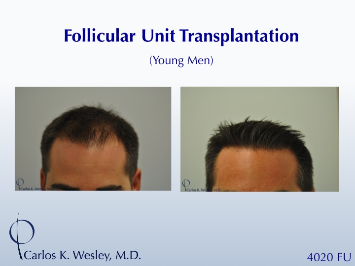 What a difference the 4020 grafts made in this young man's life!

Interactive before/After images may also be viewed here:
www.drcarloswesley.com/frontal_13.html

A video of this patient's experience can be seen here:
www.drcarloswesley.com/videos_07.html