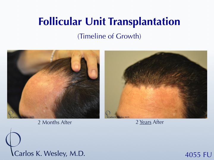 The timeline of hair growth (2 months versus 2 years) can be appreciated in these images from a patient receiving 4055 grafts from Dr. Carlos K. Wesley in New York City.

A video of this patient's experience with Dr. Wesley can be viewed here:
https://vimeo.com/64922030