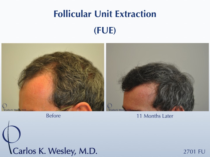 Follicular Unit Extraction (FUE) with Dr. Carlos K. Wesley in New York City.  Before/After 2701 FUE grafts using a combination of 0.8mm and 0.9mm motorized punches.

The first postoperative week of this patient's experience with Dr. Wesley can be viewed here:
www.drcarloswesley.com/videos_11.html