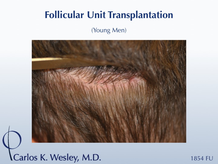 The patient's nearly imperceptible donor scar after the strip harvest session with Dr. Wesley.