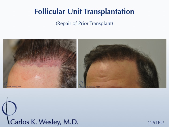 Before/After 1251 grafts
Dr. Wesley repairs a hairline initially transplanted by a different surgeon.  The patient's wide donor scar was also minimized by Dr. Wesley during the repair session.

An interactive before/after of this patient's results can be viewed at:
www.drcarloswesley.com/conceal_scarring01.html