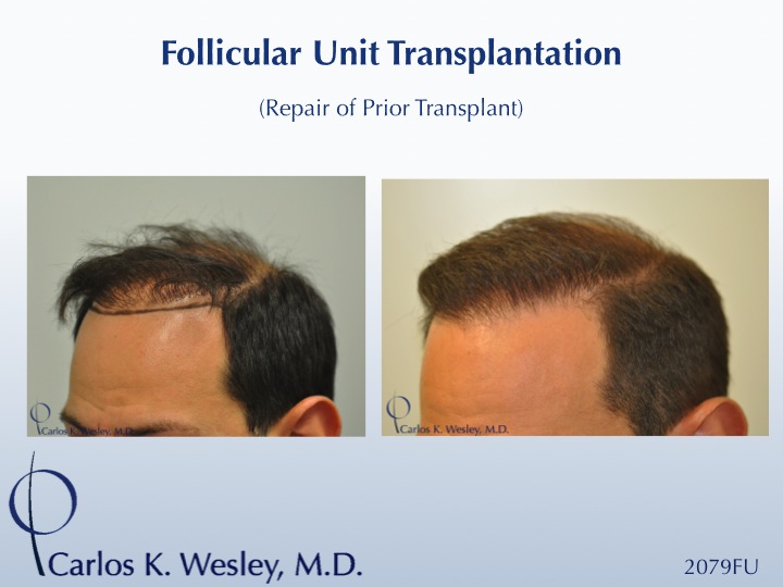 Softening a "pluggy" appearing hairline can be achieved in a single session. This 42-year-old male had previously undergone two hair transplants that left him with an unnatural appearing hairline. Dr. Wesley effectively softened his hairline and, after only seven months, the patient was already beginning to benefit from this repair session consisting of 2079 micro grafts.

An interactive before/after image of this patient can be viewed here:
www.drcarloswesley.com/soften_a_pluggy_appearance.html