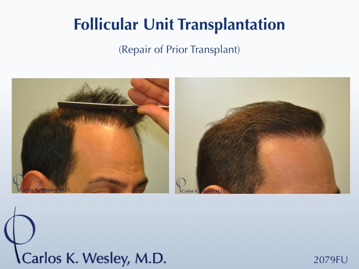Softening a "pluggy" appearing hairline can be achieved in a single session. This 42-year-old male had previously undergone two hair transplants that left him with an unnatural appearing hairline. Dr. Wesley effectively softened his hairline and, after only seven months, the patient was already beginning to benefit from this repair session consisting of 2079 micro grafts.

An interactive before/after image of this patient can be viewed here:
www.drcarloswesley.com/soften_a_pluggy_appearance.html

A video of this patient's experience can also be seen here:
www.drcarloswesley.com/videos_14.html