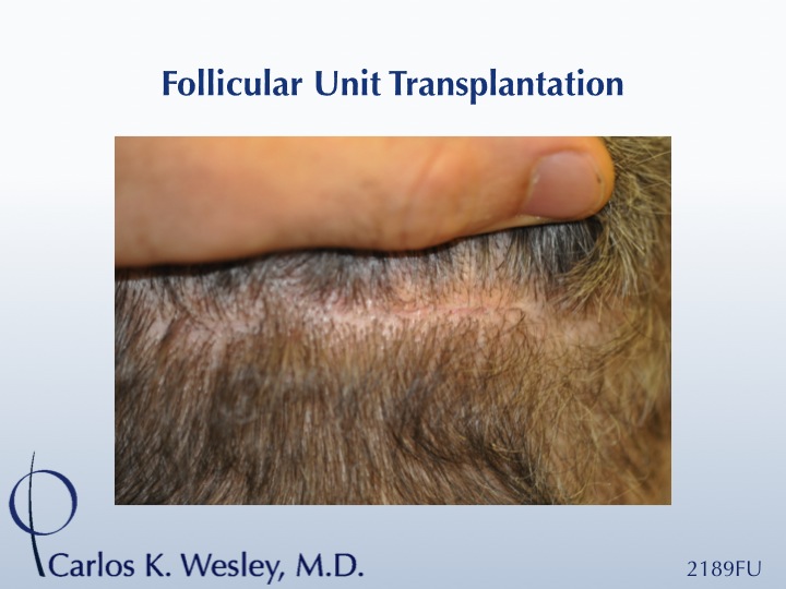 The patient's donor scar after a 2189-grafts session of FUT.