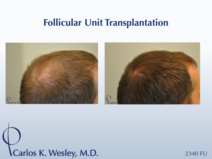 This 25-year-old patient had tried finasteride 1mg (Propecia) prior to his decision to treat his thinning mid scalp with surgical hair restoration. He stopped Propecia months before his session and has not taken it since.

An interactive before/after image of this patient can be viewed here:
www.drcarloswesley.com/midscalp_05.html

A video of this patient's experience with Dr. Wesley can be viewed here:
www.drcarloswesley.com/videos_18.html