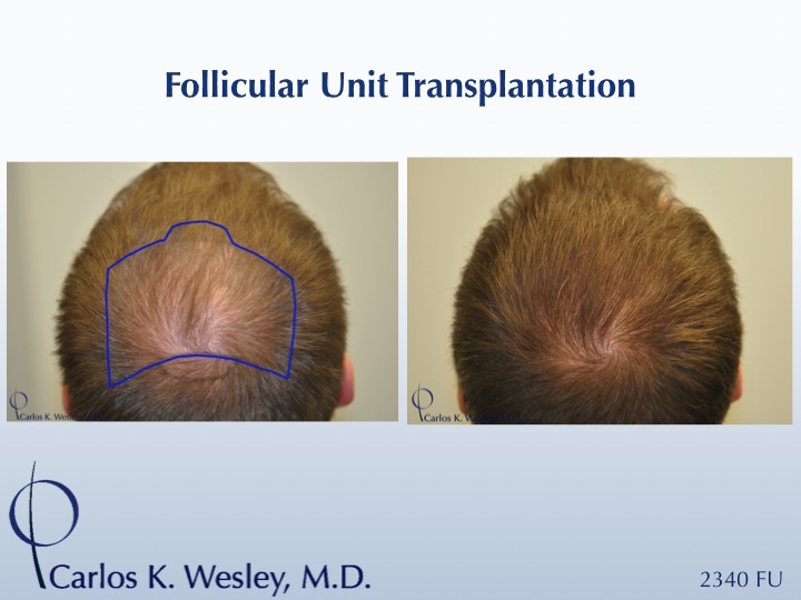 An outline of the mid scalp region treated.

An interactive before/after image of this patient can be viewed here:
www.drcarloswesley.com/midscalp_05.html

A video of this patient's experience with Dr. Wesley can be viewed here:
www.drcarloswesley.com/videos_18.html