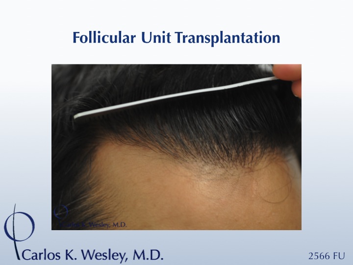 Detailed image of the patient's hairline post-transplantation.

An interactive before/after image of this patient may be seen here:
www.drcarloswesley.com/frontal_03.html

A video of this patient's experience with Dr. Wesley may be viewed here:
www.drcarloswesley.com/videos_19.html