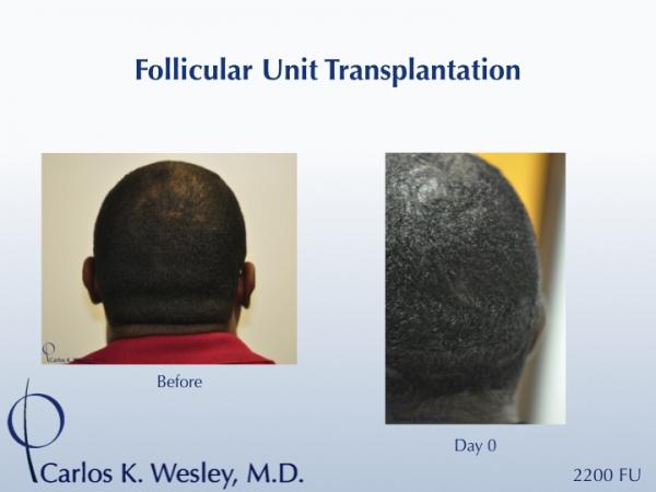 Patients are not required to shave their heads for a traditional strip harvest approach to hair restoration surgery. Instead, they are encouraged to wear their hair at a minimum of 3/4" in length. However, Dr. Wesley is able to achieve an effective camouflage of sutures in the donor area in patients with even shorter hair length.

A video of this patient's experience with Dr. Wesley (NYC) can be viewed here:
www.drcarloswesley.com/videos_06.html
