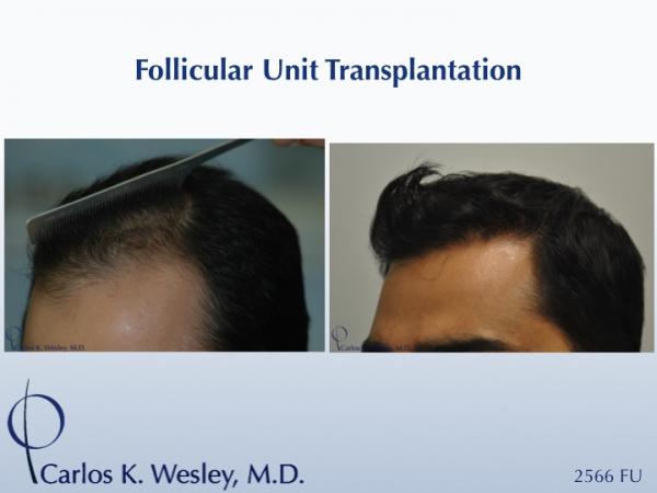 This patient presented at age 30 with coarse straight black hair that had progressively receded throughout his frontal third. A session involving 2566 micrografts throughout the frontal region of his scalp provided considerable coverage to the area that bothered him most.

An interactive before/after image of this patient may be seen here:
www.drcarloswesley.com/frontal_03.html

A video of this patient's experience with Dr. Wesley may be viewed here:
www.drcarloswesley.com/videos_19.html