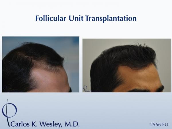 This patient presented at age 30 with coarse straight black hair that had progressively receded throughout his frontal third. A session involving 2566 micrografts throughout the frontal region of his scalp provided considerable coverage to the area that bothered him most.

An interactive before/after image of this patient may be seen here:
www.drcarloswesley.com/frontal_03.html

A video of this patient's experience with Dr. Wesley may be viewed here:
www.drcarloswesley.com/videos_19.html