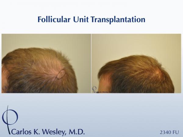 This 25-year-old patient had tried finasteride 1mg (Propecia) prior to his decision to treat his thinning mid scalp with surgical hair restoration. He stopped Propecia months before his session and has not taken it since.

An interactive before/after image of this patient can be viewed here:
www.drcarloswesley.com/midscalp_05.html

A video of this patient's experience with Dr. Wesley can be viewed here:
www.drcarloswesley.com/videos_18.html
