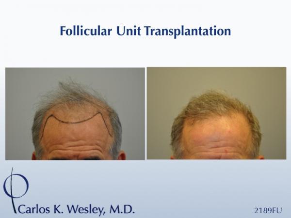 Before/After a 2189 FU session with Dr. Carlos K. Wesley in New York City.