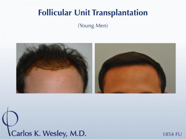 This 24-year-old man underwent an 1854 graft session with Dr. Carlos K. Wesley in New York City. Before/After images (as well as intraoperative images) can be viewed.

This, along with other "favorite" hairlines designed by Dr. Wesley may by viewed in this video:
www.drcarloswesley.com/videos.html