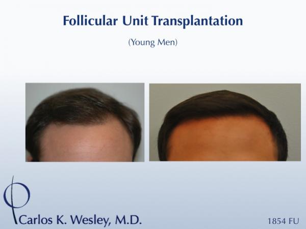 This 24-year-old man underwent an 1854 graft session with Dr. Carlos K. Wesley in New York City. Before/After images (as well as intraoperative images) can be viewed.

This, along with other "favorite" hairlines designed by Dr. Wesley may by viewed in this video:
www.drcarloswesley.com/videos.html