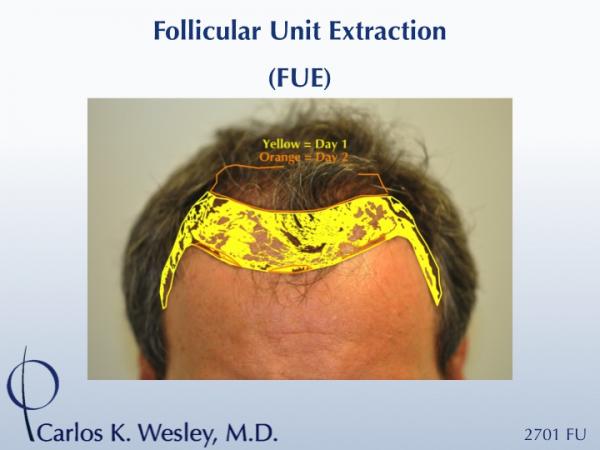 An illustration of the approach used by Dr. Carlos K. Wesley during this patient's two-day FUE session.

The first postoperative week of this patient's experience with Dr. Wesley can be viewed here:
www.drcarloswesley.com/videos_11.html