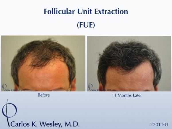 Follicular Unit Extraction (FUE) with Dr. Carlos K. Wesley in New York City. Before/After 2701 FUE grafts using a combination of 0.8mm and 0.9mm motorized punches.

The first postoperative week of this patient's experience with Dr. Wesley can be viewed here:
www.drcarloswesley.com/videos_11.html