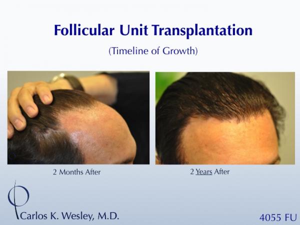 The timeline of hair growth (2 months versus 2 years) can be appreciated in these images from a patient receiving 4055 grafts from Dr. Carlos K. Wesley in New York City.

A video of this patient's experience with Dr. Wesley can be viewed here:
https://vimeo.com/64922030