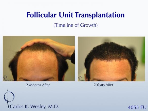 The timeline of hair growth (2 months versus 2 years) can be appreciated in these images from a patient receiving 4055 grafts from Dr. Carlos K. Wesley in New York City.

A video of this patient's experience with Dr. Wesley can be viewed here:
https://vimeo.com/64922030